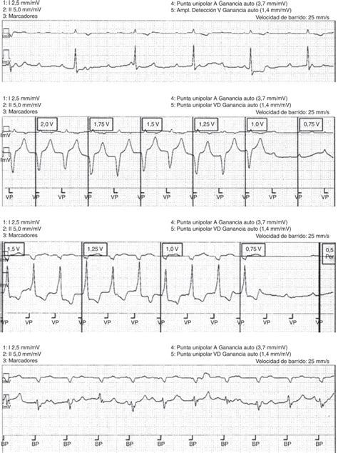 Trazos electrocardiográficos en dos derivaciones I II velocidad