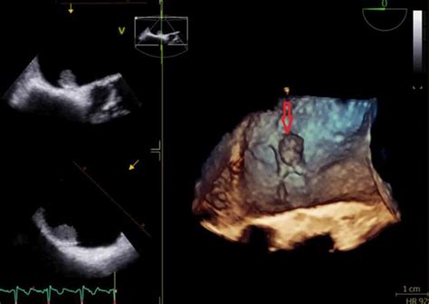 B Three Dimensional Transesophageal Echocardiography Left Atrial Tumor Download Scientific