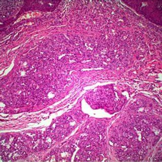 Photomicrograph Showing Histopathological Characteristics Hematoxylin