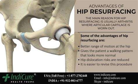 Zebra With Hip Replacement at Terry Haskell blog