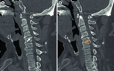 A Known Large Bony Spur On C4 5 Level White Arrow B Ossification