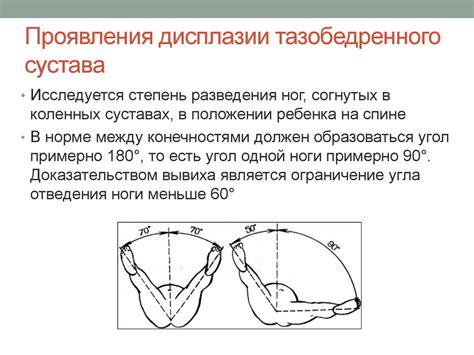 Дисплазия тазобедренных суставов: причины развития, симптоматика и ...
