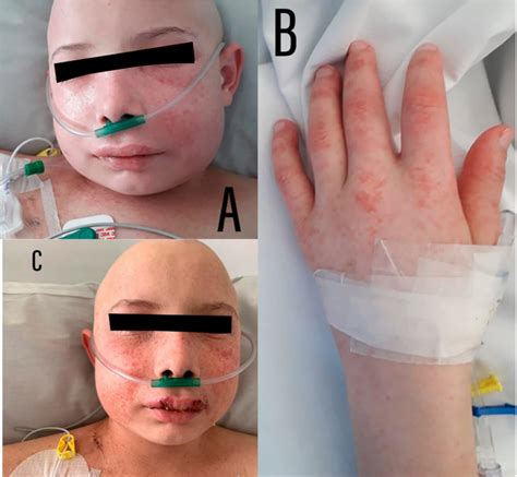 A Clinical Aspect At D8 Showing Diffuse Facial Edema And Erythema