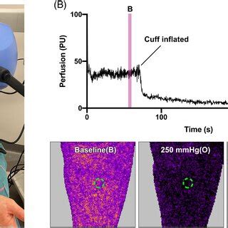 Illustration of the clinical Laser speckle contrast imaging (LSCI ...