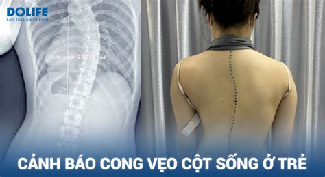 Cong Vẹo Cột Sống ở Trẻ Dấu Hiệu Nguyên Nhân Và Giải Pháp Bệnh Viện Quốc Tế Dolife