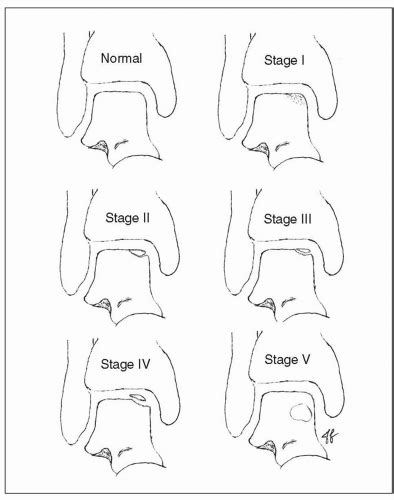 Osteochondral Defect Classification Mri