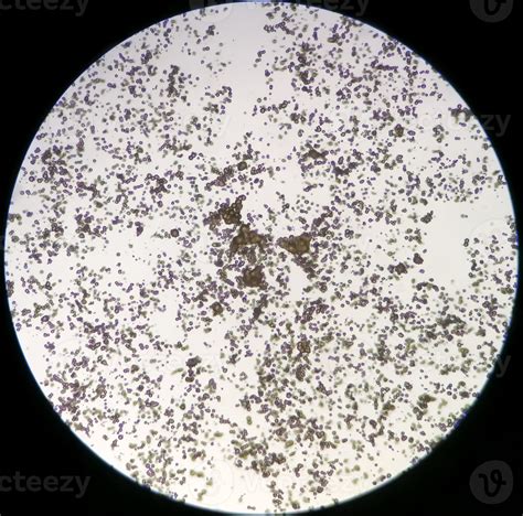 Microscopic image of Urinalysis. Abnormal urine exam. Uric acid