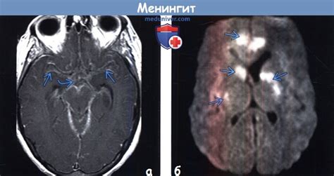 Менингит фото мозга