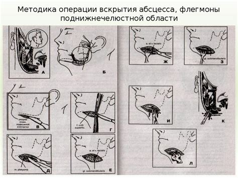 Абсцесс, флегмона поднижнечелюстной области