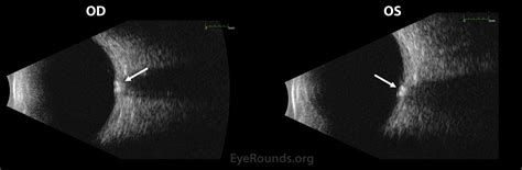 Atlas Entry - Optic Disc Drusen