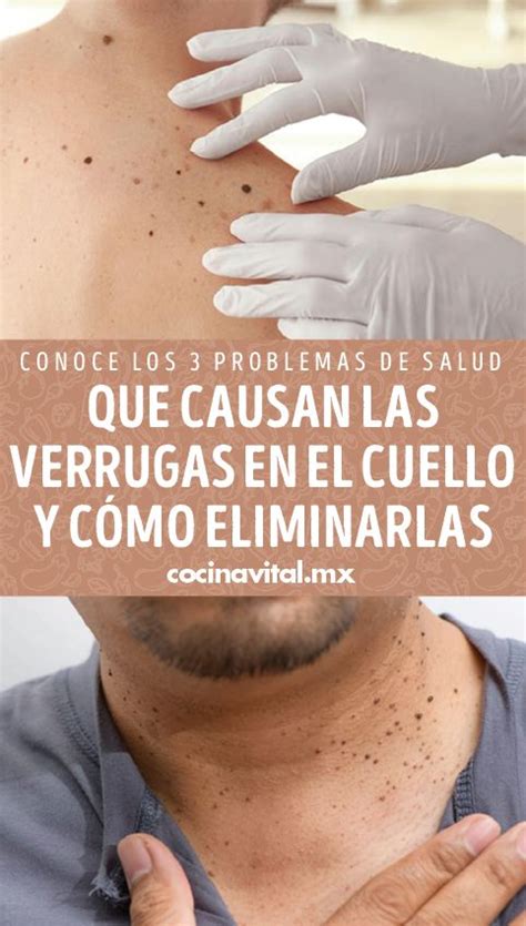Conoce Los 3 Problemas De Salud Que Causan Las Verrugas En El Cuello Y
