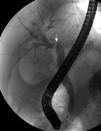 Anastomotic Stricture After Living Donor Liver Transplantation