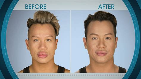 Overly Puffed Pout from Botched Patients Before and After: Shocking ...