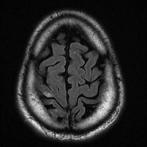 Axial Diffusion Weighted Mri Imaging Demonstrating Acute Ischemic