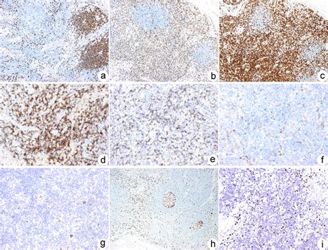 Immunohistochemical Staining Of The Lymph Node Tissue Cd20 Positive Download Scientific