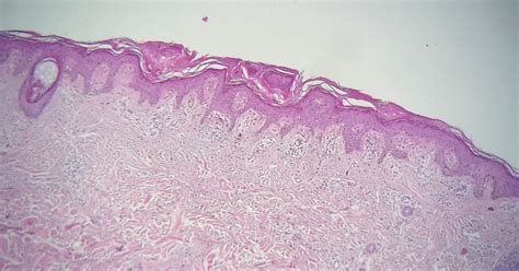 Cdpath Dermatology Lichenmacular Amyloidosis