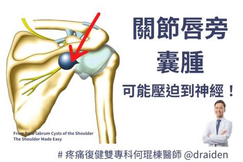 肩膀痛 何琨棟醫師 Dr Aiden