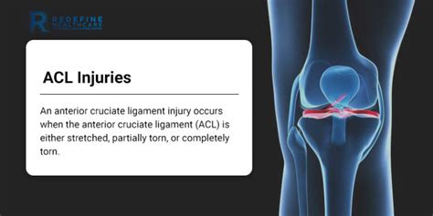 Acl Injuries Nj S Top Orthopedic Spine And Pain Management Center