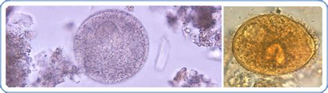 Giardiasis Balantidiasis Isosporiasis And Microsporidiosis Enetmd