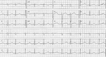 ECG Case 076 • LITFL • ECG Top 100 Self-Assessment Quiz