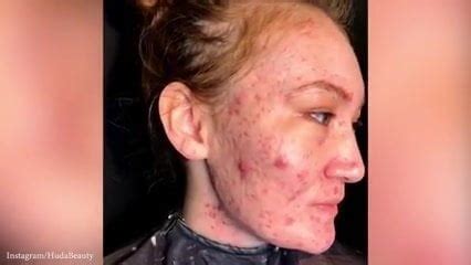 Free Acne Porn Videos XHamster