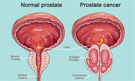 Why You Should Know About Prostate Cancer Daily Trust