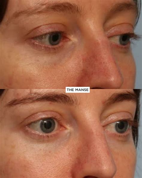 Tear Trough Treatments Best Cosmetic Clinic Sydney Advanced