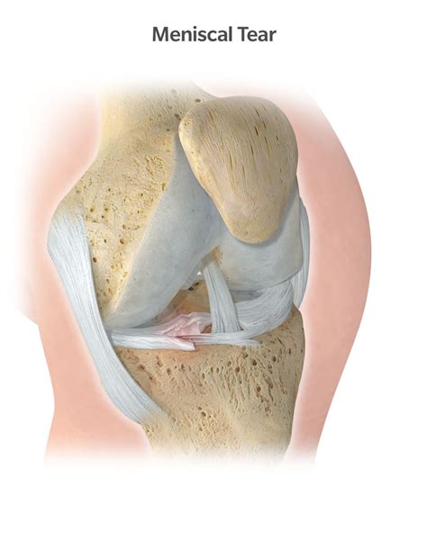 Knee Pain Explained