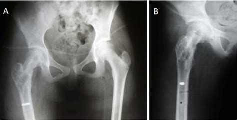 A Frontal View X Ray B Axial View Of The Right Hip After Two Years