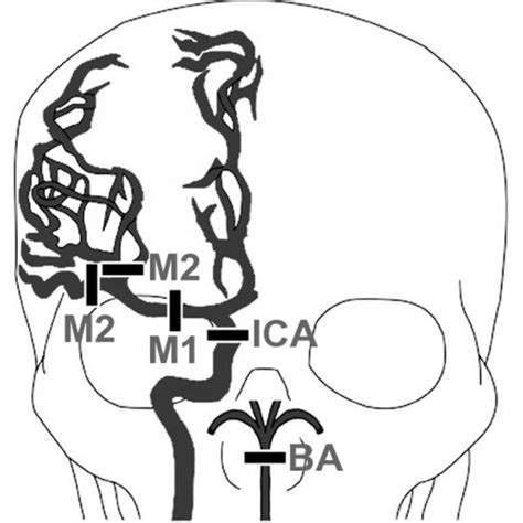 Middle Cerebral Artery Occlusion