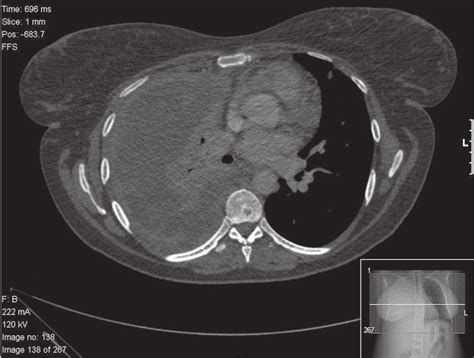 Lung Cancer Pleural Effusion