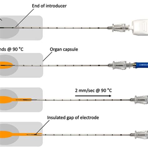 The Four Basic Steps Used In Performing Coaxial Core Biopsies Followed