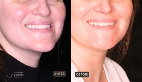 Mentoplastia Antes E Depois - Mentoplastia de Redução: por que pode ser a opção para você
