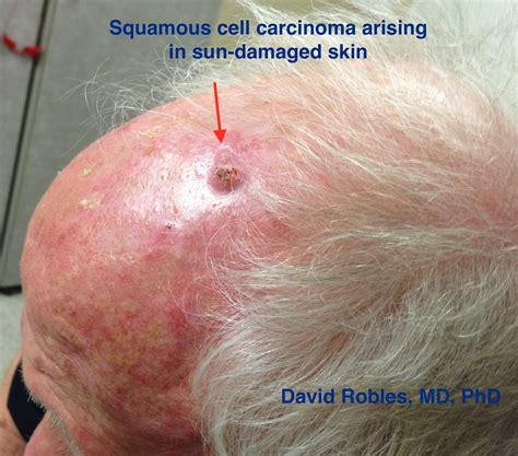 Squamous Cell Carcinoma By David Robles Md Phd