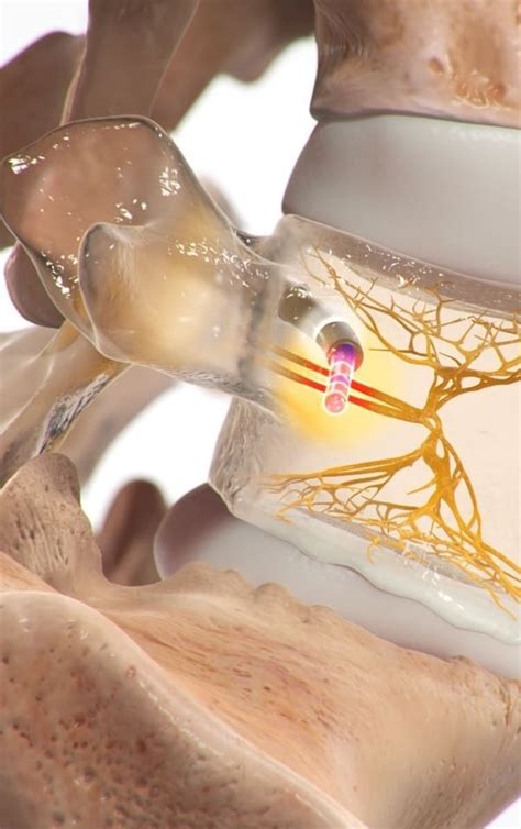 Intracept Procedure For Chronic Low Back Pain Orthounited