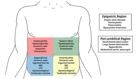 Acute Abdomen Medizzy