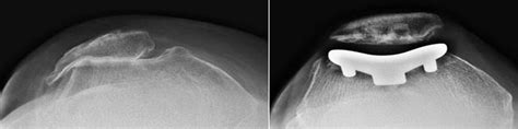 Patellofemoral Replacement Orthoinfo Aaos