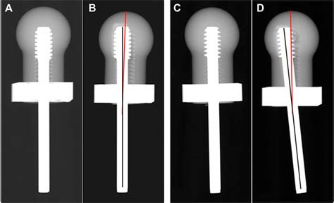 Frontiers Biomechanical Comparison Of The Undercut Thread Design