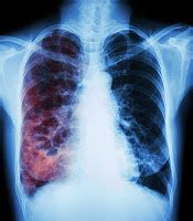 tuberculosis pulmonar: marzo 2017