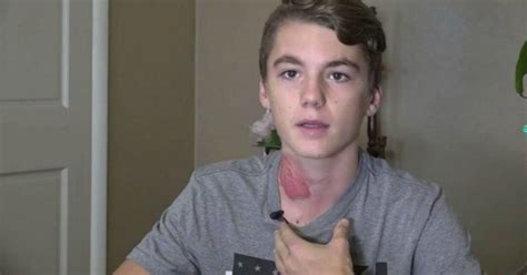 Another Horrific Internet Trend Called Hot Water Challenge Is Landing Us Teens In The Er