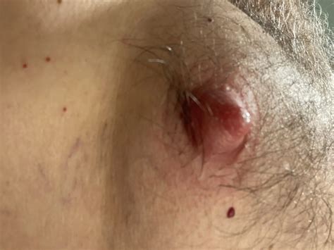 Nipple Suctioning Gets Them Bigger Nude Pics XHamster