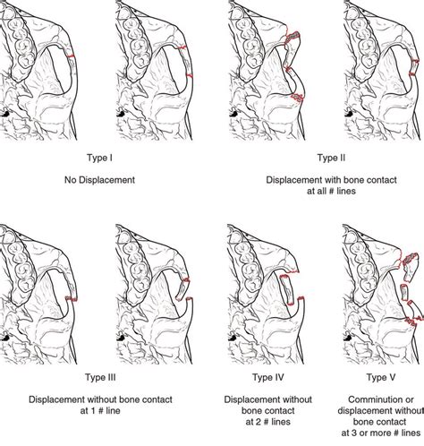 Zygomaticomaxillary Complex Fractures Workup Imaging