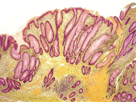 Colorectal Polyp Light Micrograph[01809038140]の写真素材・イラスト素材｜アマナイメージズ