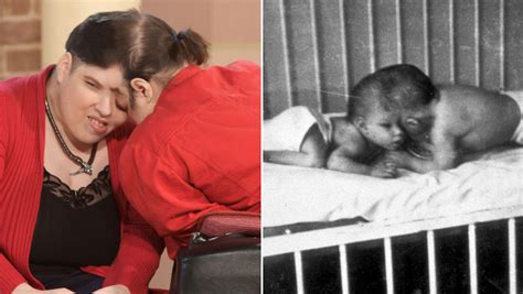 Worlds OLDEST Conjoined Twins Lori George Schappell DEAD At 62