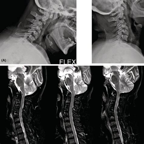 Evidence Of Skull Base Osteomyelitis In CT And MRI A Coronal And