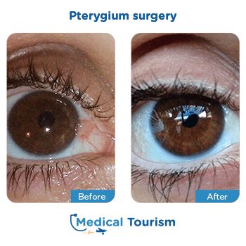 International Clinics For Pterygium Medical Tourism Mexico