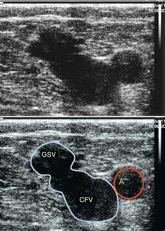 Examination Of The Great Saphenous Vein Radiology Key