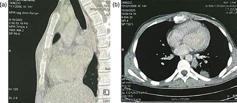 Chest Ct Scan Showing An Osteolytic Tissue Mass Centred On The Sternum