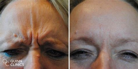 Botox Frown Lines Before And After