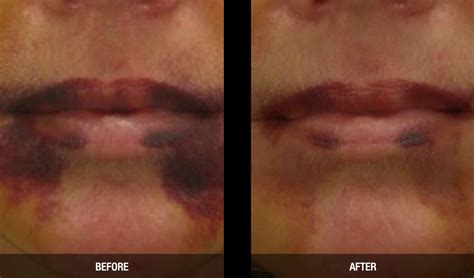 Vbeam Perfecta Port Wine Stain Kitagawa Dermatology